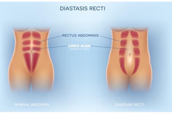 What Non-Surgical Options Are Available for Diastasis Recti Sunbury Common?