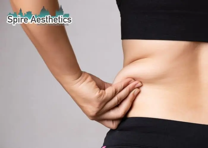 Image of woman pinching fat on their hips Sunbury Common. Fat Freezing treatment