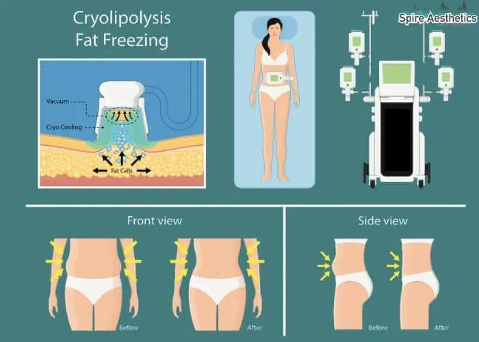 Fat freezing treatment Sunbury Common benefits for competitions to remove stubborn fat deposits.