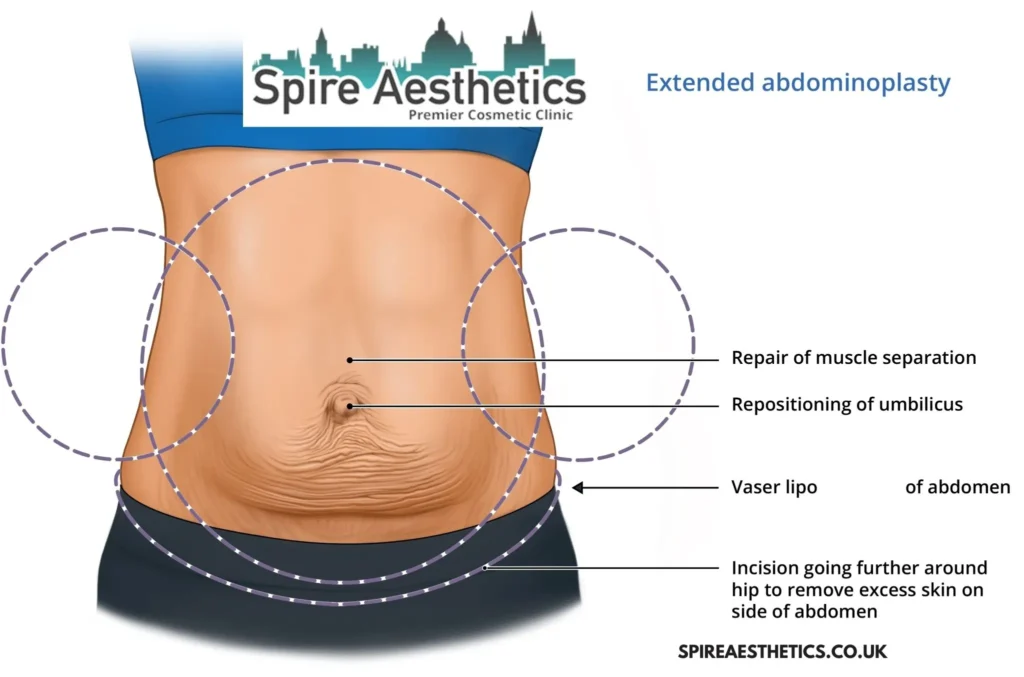 Understanding Loose Skin After Gastric Band Sunbury Common Surgery and HIFU Treatment