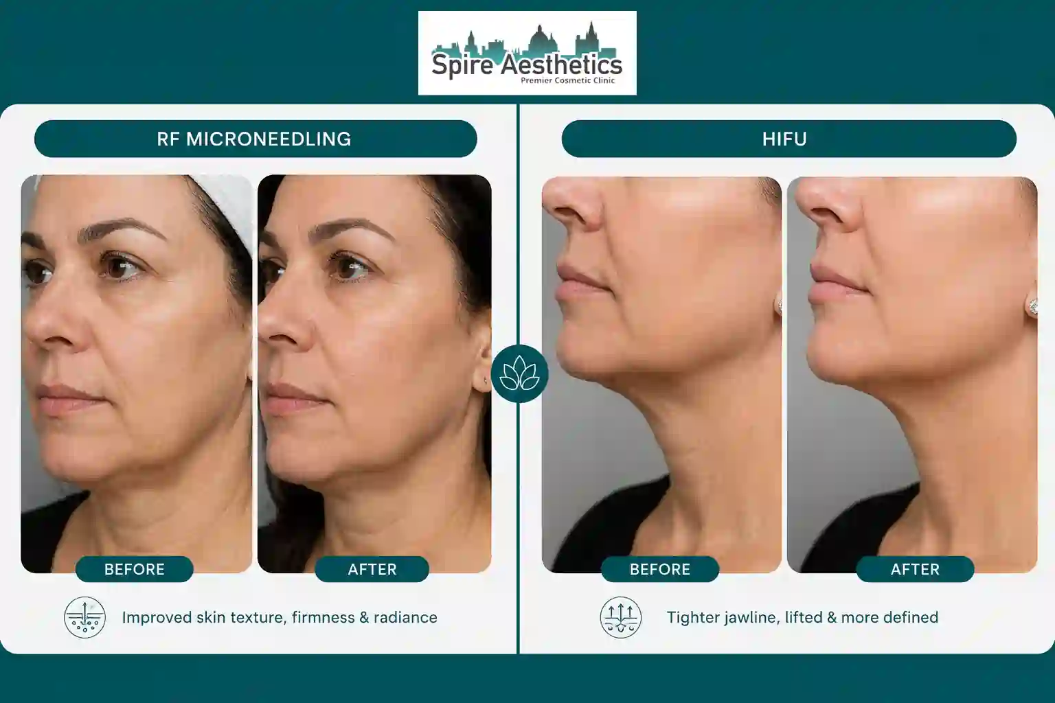 Can RF Microneedling and HIFU Be Combined Sunbury Common?